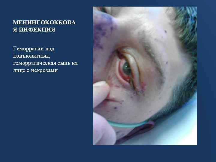 МЕНИНГОКОККОВА Я ИНФЕКЦИЯ Геморрагии под конъюнктивы, геморрагическая сыпь на лице с некрозами 
