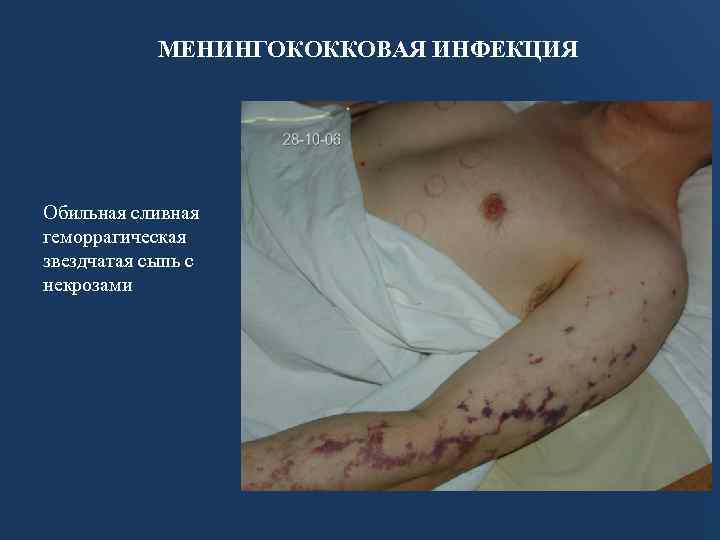 МЕНИНГОКОККОВАЯ ИНФЕКЦИЯ Обильная сливная геморрагическая звездчатая сыпь с некрозами 