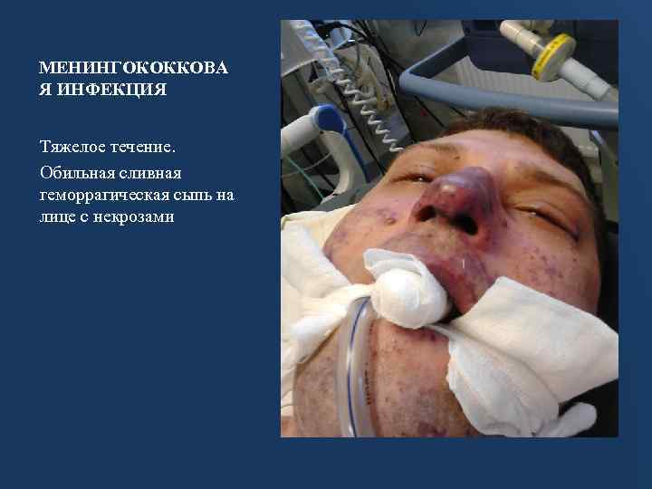 МЕНИНГОКОККОВА Я ИНФЕКЦИЯ Тяжелое течение. Обильная сливная геморрагическая сыпь на лице с некрозами 