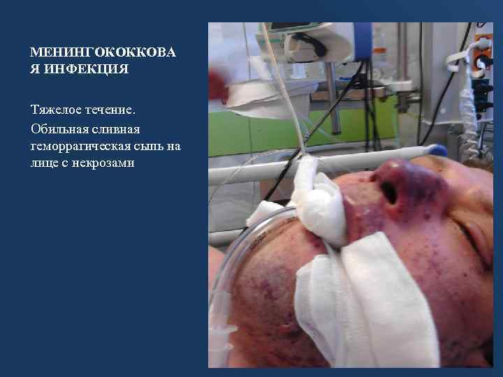 МЕНИНГОКОККОВА Я ИНФЕКЦИЯ Тяжелое течение. Обильная сливная геморрагическая сыпь на лице с некрозами 