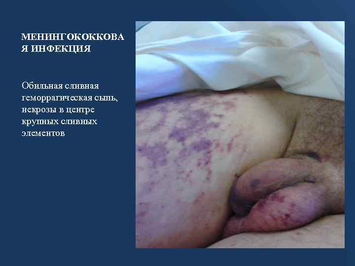 МЕНИНГОКОККОВА Я ИНФЕКЦИЯ Обильная сливная геморрагическая сыпь, некрозы в центре крупных сливных элементов 