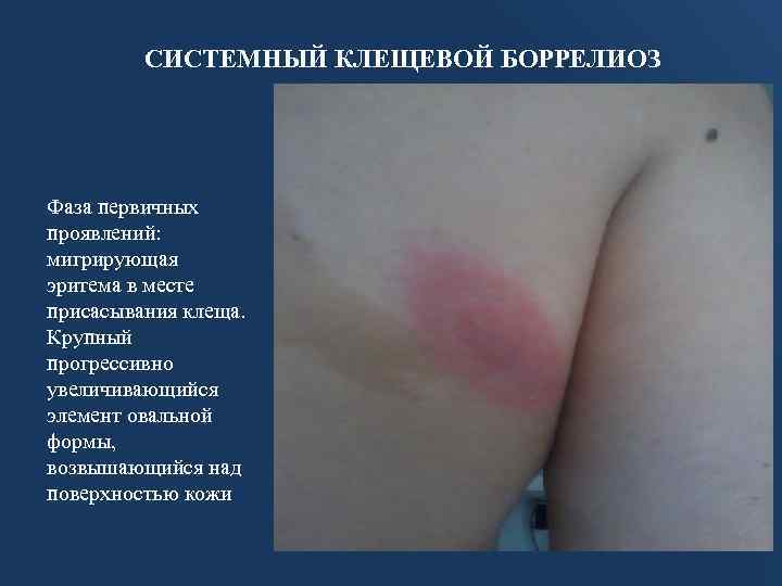 СИСТЕМНЫЙ КЛЕЩЕВОЙ БОРРЕЛИОЗ Фаза первичных проявлений: мигрирующая эритема в месте присасывания клеща. Крупный прогрессивно