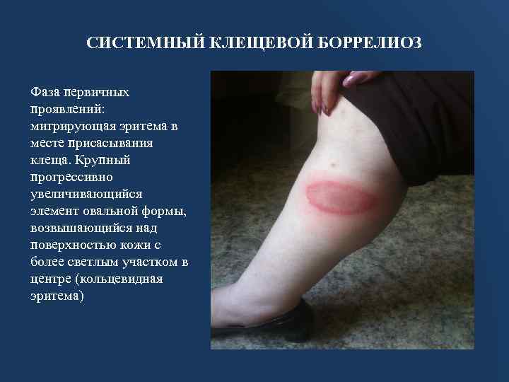 СИСТЕМНЫЙ КЛЕЩЕВОЙ БОРРЕЛИОЗ Фаза первичных проявлений: мигрирующая эритема в месте присасывания клеща. Крупный прогрессивно