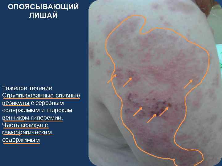 ОПОЯСЫВАЮЩИЙ ЛИШАЙ Тяжелое течение. Сгруппированные сливные везикулы с серозным содержимым и широким венчиком гиперемии.