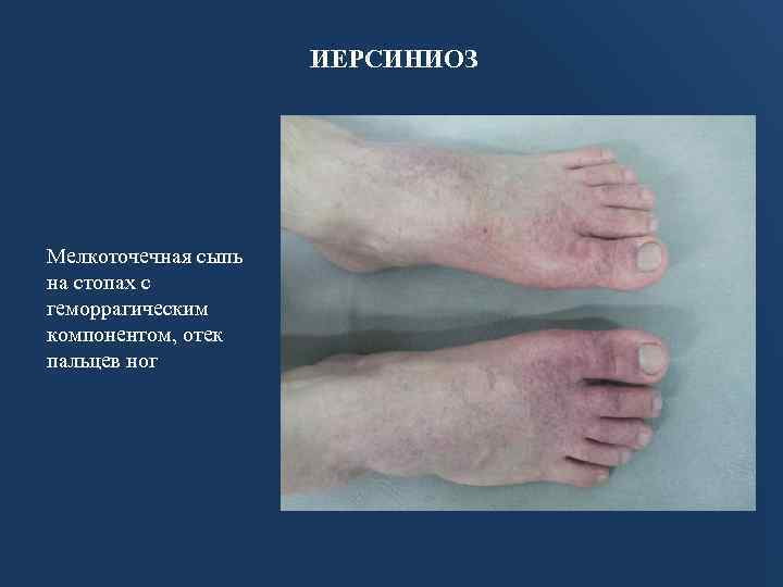 ИЕРСИНИОЗ Мелкоточечная сыпь на стопах с геморрагическим компонентом, отек пальцев ног 