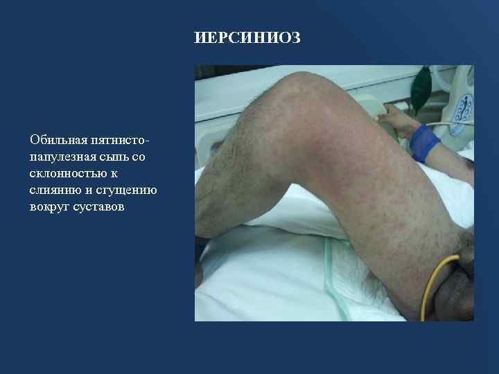 ИЕРСИНИОЗ Обильная пятнистопапулезная сыпь со склонностью к слиянию и сгущению вокруг суставов 