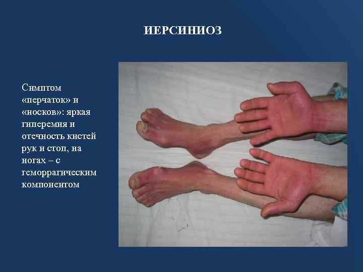 ИЕРСИНИОЗ Симптом «перчаток» и «носков» : яркая гиперемия и отечность кистей рук и стоп,