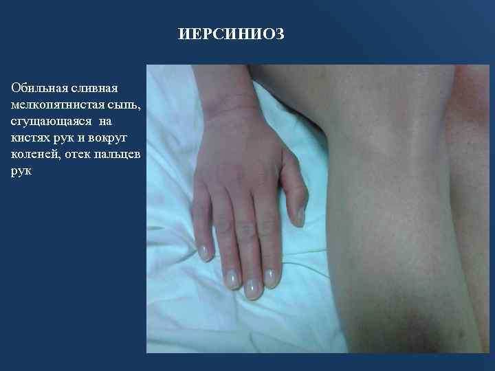 ИЕРСИНИОЗ Обильная сливная мелкопятнистая сыпь, сгущающаяся на кистях рук и вокруг коленей, отек пальцев