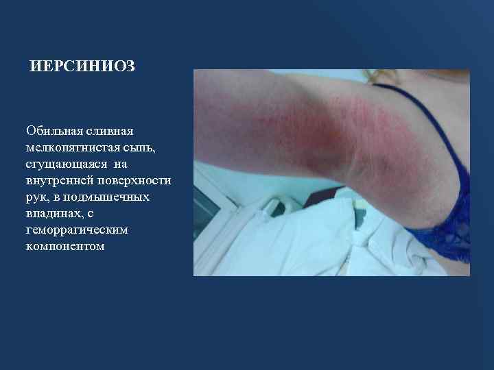 ИЕРСИНИОЗ Обильная сливная мелкопятнистая сыпь, сгущающаяся на внутренней поверхности рук, в подмышечных впадинах, с