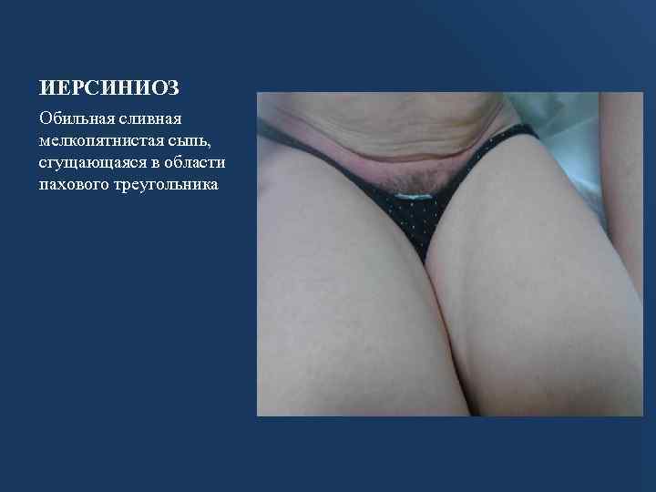 ИЕРСИНИОЗ Обильная сливная мелкопятнистая сыпь, сгущающаяся в области пахового треугольника 