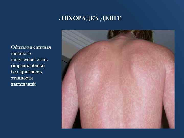 ЛИХОРАДКА ДЕНГЕ Обильная сливная пятнистопапулезная сыпь (кореподобная) без признаков этапности высыпаний 