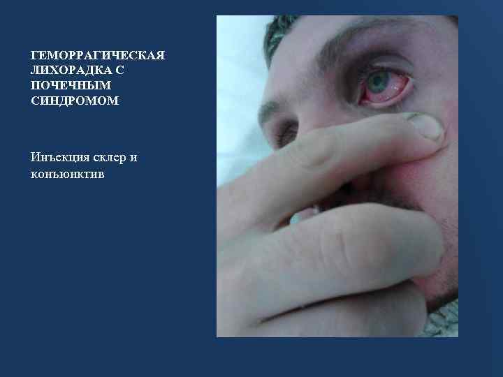 ГЕМОРРАГИЧЕСКАЯ ЛИХОРАДКА С ПОЧЕЧНЫМ СИНДРОМОМ Инъекция склер и конъюнктив 