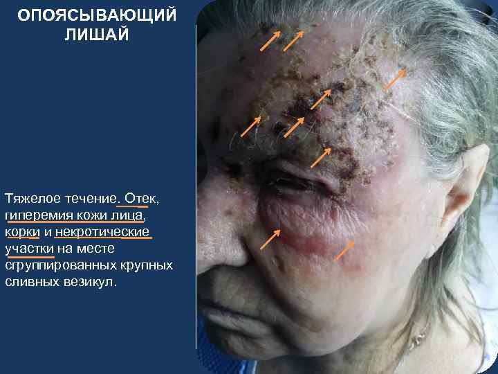 ОПОЯСЫВАЮЩИЙ ЛИШАЙ Тяжелое течение. Отек, гиперемия кожи лица, корки и некротические участки на месте