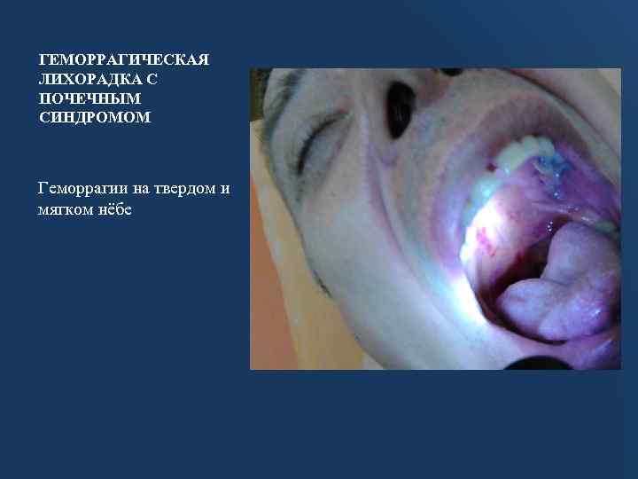 ГЕМОРРАГИЧЕСКАЯ ЛИХОРАДКА С ПОЧЕЧНЫМ СИНДРОМОМ Геморрагии на твердом и мягком нёбе 