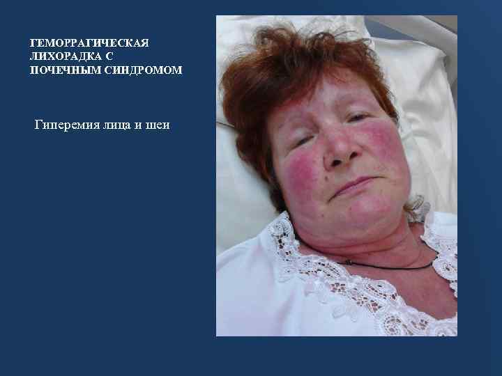 ГЕМОРРАГИЧЕСКАЯ ЛИХОРАДКА С ПОЧЕЧНЫМ СИНДРОМОМ Гиперемия лица и шеи 