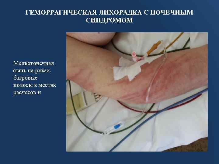 ГЕМОРРАГИЧЕСКАЯ ЛИХОРАДКА С ПОЧЕЧНЫМ СИНДРОМОМ Мелкоточечная сыпь на руках, багровые полосы в местах расчесов