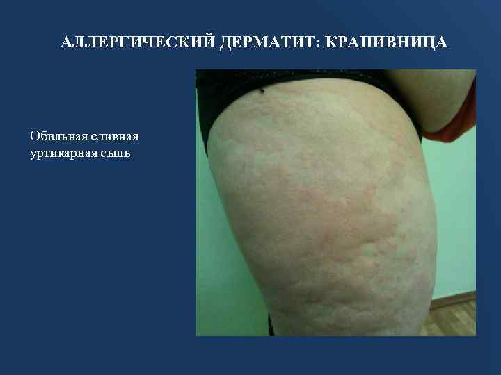 АЛЛЕРГИЧЕСКИЙ ДЕРМАТИТ: КРАПИВНИЦА Обильная сливная уртикарная сыпь 