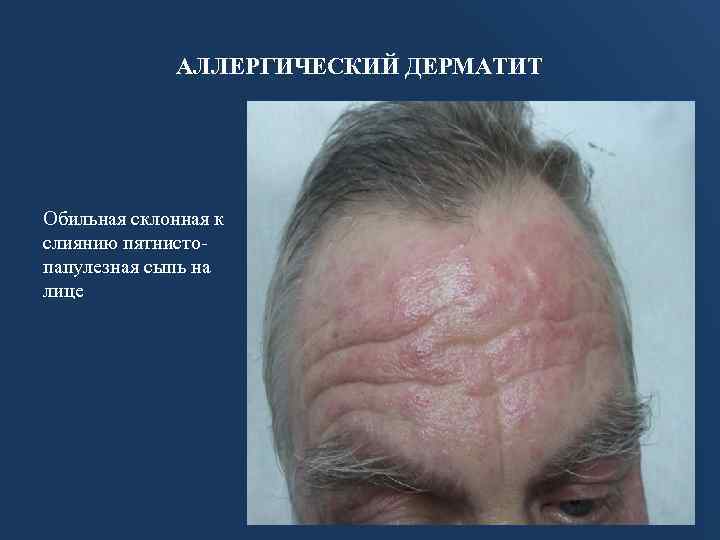 АЛЛЕРГИЧЕСКИЙ ДЕРМАТИТ Обильная склонная к слиянию пятнистопапулезная сыпь на лице 