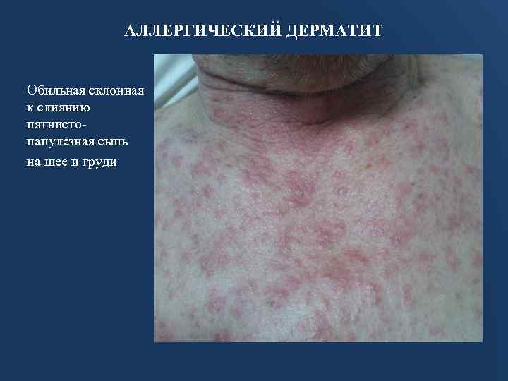 АЛЛЕРГИЧЕСКИЙ ДЕРМАТИТ Обильная склонная к слиянию пятнистопапулезная сыпь на шее и груди 