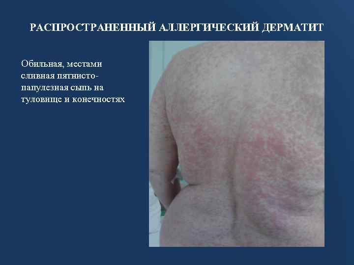 РАСПРОСТРАНЕННЫЙ АЛЛЕРГИЧЕСКИЙ ДЕРМАТИТ Обильная, местами сливная пятнистопапулезная сыпь на туловище и конечностях 