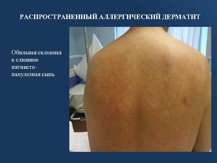 РАСПРОСТРАНЕННЫЙ АЛЛЕРГИЧЕСКИЙ ДЕРМАТИТ Обильная склонная к слиянию пятнистопапулезная сыпь 