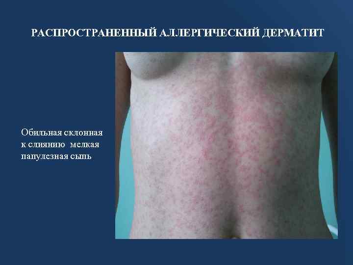 РАСПРОСТРАНЕННЫЙ АЛЛЕРГИЧЕСКИЙ ДЕРМАТИТ Обильная склонная к слиянию мелкая папулезная сыпь 