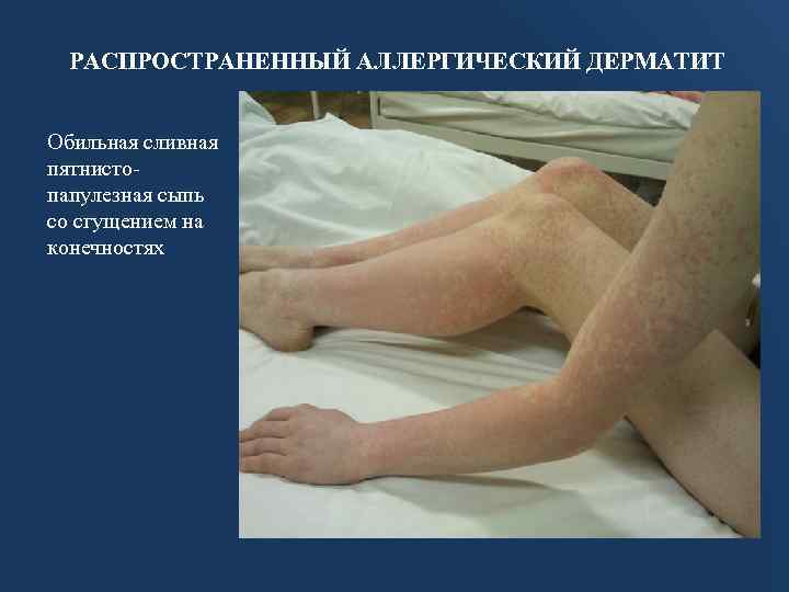 РАСПРОСТРАНЕННЫЙ АЛЛЕРГИЧЕСКИЙ ДЕРМАТИТ Обильная сливная пятнистопапулезная сыпь со сгущением на конечностях 