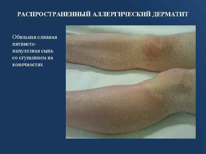 РАСПРОСТРАНЕННЫЙ АЛЛЕРГИЧЕСКИЙ ДЕРМАТИТ Обильная сливная пятнистопапулезная сыпь со сгущением на конечностях 