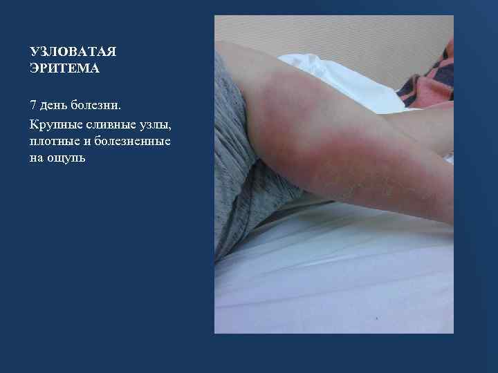 УЗЛОВАТАЯ ЭРИТЕМА 7 день болезни. Крупные сливные узлы, плотные и болезненные на ощупь 