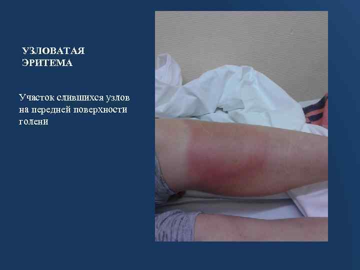 УЗЛОВАТАЯ ЭРИТЕМА Участок слившихся узлов на передней поверхности голени 