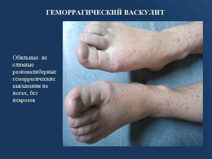 ГЕМОРРАГИЧЕСКИЙ ВАСКУЛИТ Обильные не сливные разнокалиберные геморрагические высыпания на ногах, без некрозов 