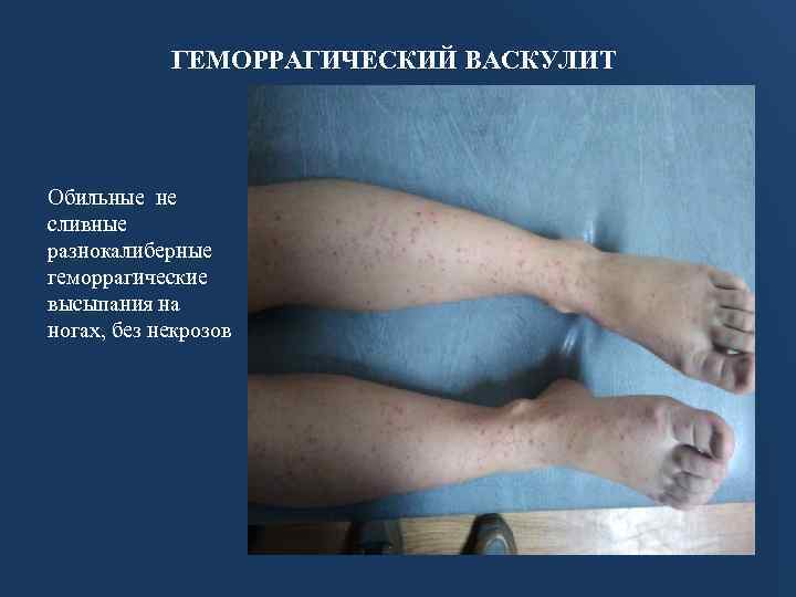 ГЕМОРРАГИЧЕСКИЙ ВАСКУЛИТ Обильные не сливные разнокалиберные геморрагические высыпания на ногах, без некрозов 