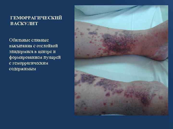 ГЕМОРРАГИЧЕСКИЙ ВАСКУЛИТ Обильные сливные высыпания с отслойкой эпидермиса в центре и формированием пузырей с