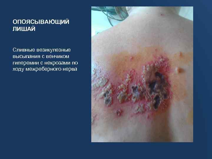 ОПОЯСЫВАЮЩИЙ ЛИШАЙ Сливные везикулезные высыпания с венчиком гиперемии с некрозами по ходу межреберного нерва