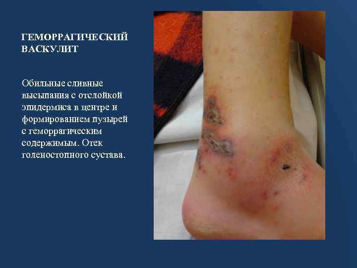 ГЕМОРРАГИЧЕСКИЙ ВАСКУЛИТ Обильные сливные высыпания с отслойкой эпидермиса в центре и формированием пузырей с