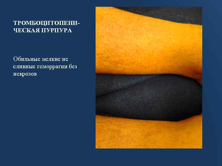 ТРОМБОЦИТОПЕНИЧЕСКАЯ ПУРПУРА Обильные мелкие не сливные геморрагии без некрозов 