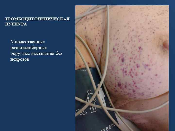 ТРОМБОЦИТОПЕНИЧЕСКАЯ ПУРПУРА Множественные разнокалиберные округлые высыпания без некрозов 