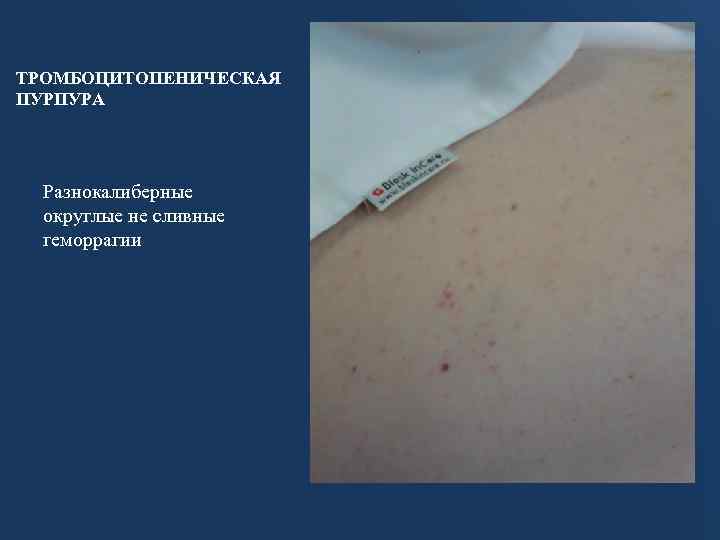 ТРОМБОЦИТОПЕНИЧЕСКАЯ ПУРПУРА Разнокалиберные округлые не сливные геморрагии 