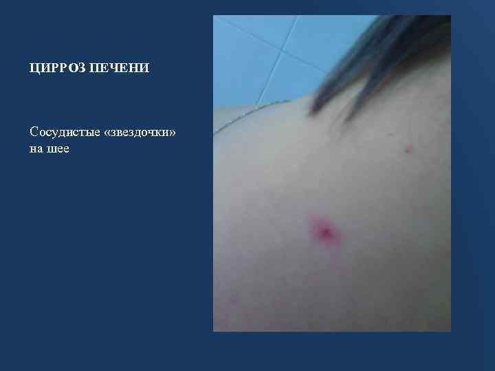 ЦИРРОЗ ПЕЧЕНИ Сосудистые «звездочки» на шее 