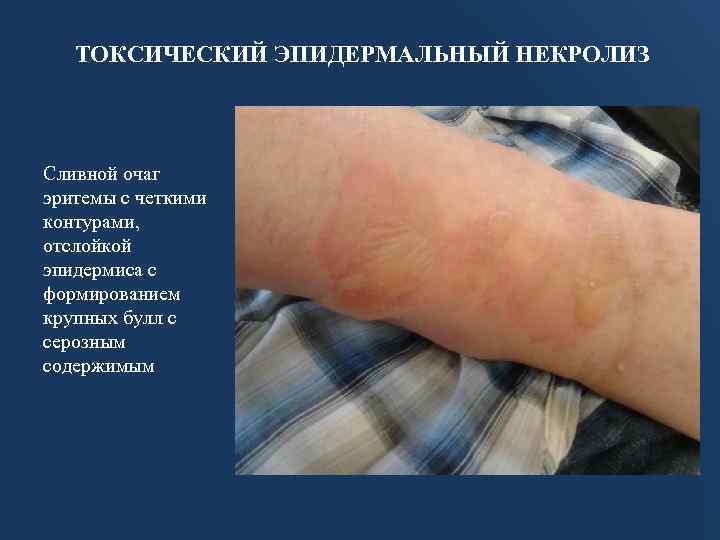ТОКСИЧЕСКИЙ ЭПИДЕРМАЛЬНЫЙ НЕКРОЛИЗ Сливной очаг эритемы с четкими контурами, отслойкой эпидермиса с формированием крупных