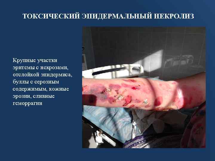 ТОКСИЧЕСКИЙ ЭПИДЕРМАЛЬНЫЙ НЕКРОЛИЗ Крупные участки эритемы с некрозами, отслойкой эпидермиса, буллы с серозным содержимым,