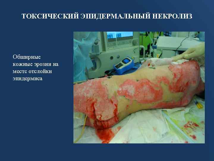 ТОКСИЧЕСКИЙ ЭПИДЕРМАЛЬНЫЙ НЕКРОЛИЗ Обширные кожные эрозии на месте отслойки эпидермиса 