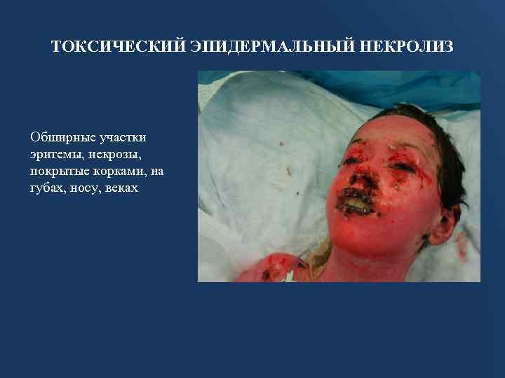 ТОКСИЧЕСКИЙ ЭПИДЕРМАЛЬНЫЙ НЕКРОЛИЗ Обширные участки эритемы, некрозы, покрытые корками, на губах, носу, веках 