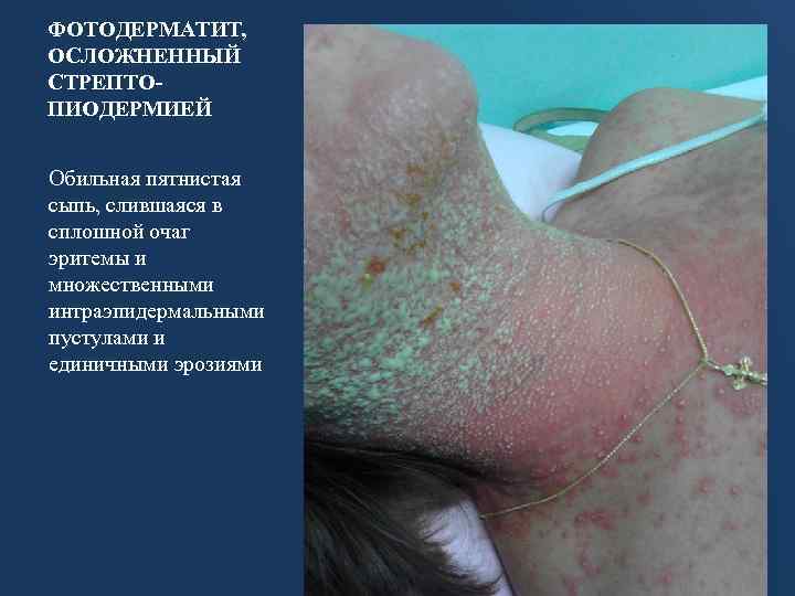 ФОТОДЕРМАТИТ, ОСЛОЖНЕННЫЙ СТРЕПТОПИОДЕРМИЕЙ Обильная пятнистая сыпь, слившаяся в сплошной очаг эритемы и множественными интраэпидермальными