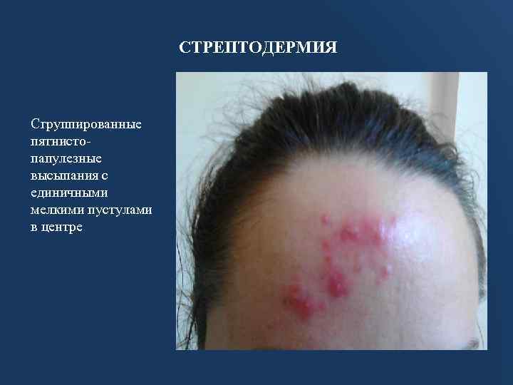 СТРЕПТОДЕРМИЯ Сгруппированные пятнистопапулезные высыпания с единичными мелкими пустулами в центре 