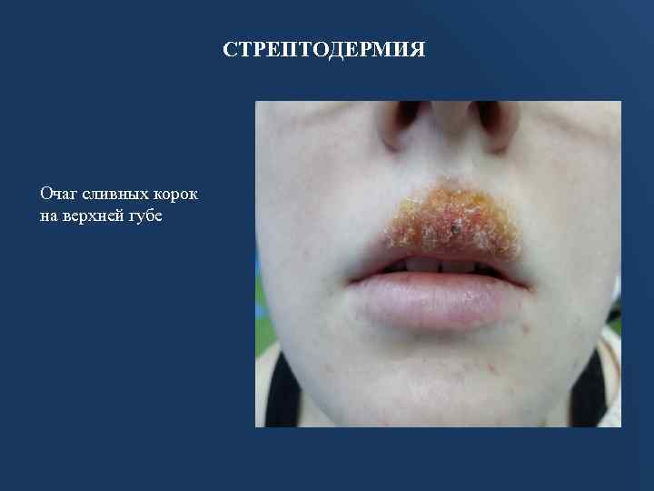 СТРЕПТОДЕРМИЯ Очаг сливных корок на верхней губе 