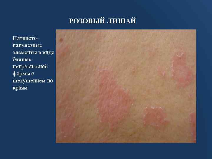 РОЗОВЫЙ ЛИШАЙ Пятнистопапулезные элементы в виде бляшек неправильной формы с шелушением по краям 