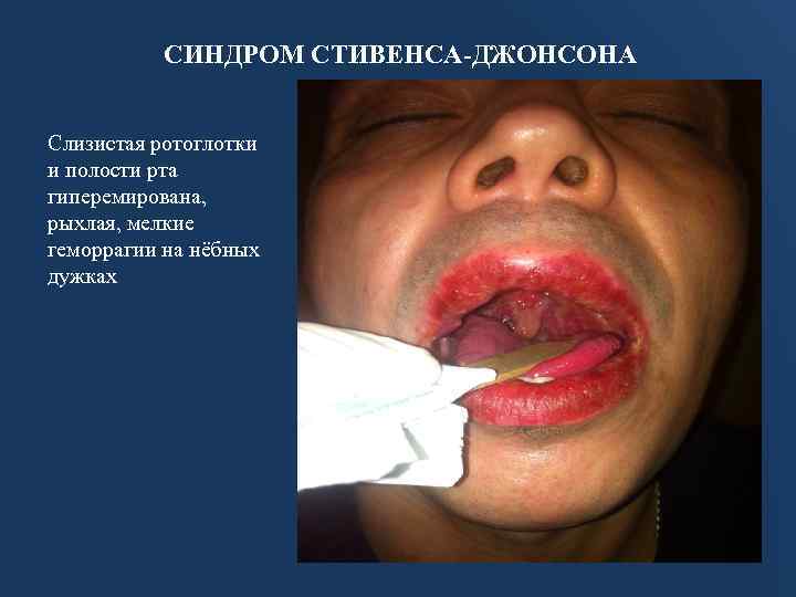 СИНДРОМ СТИВЕНСА-ДЖОНСОНА Слизистая ротоглотки и полости рта гиперемирована, рыхлая, мелкие геморрагии на нёбных дужках