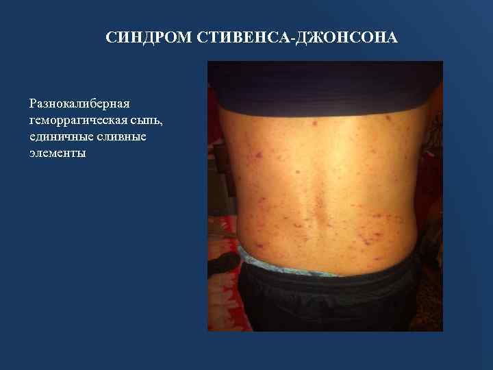 СИНДРОМ СТИВЕНСА-ДЖОНСОНА Разнокалиберная геморрагическая сыпь, единичные сливные элементы 