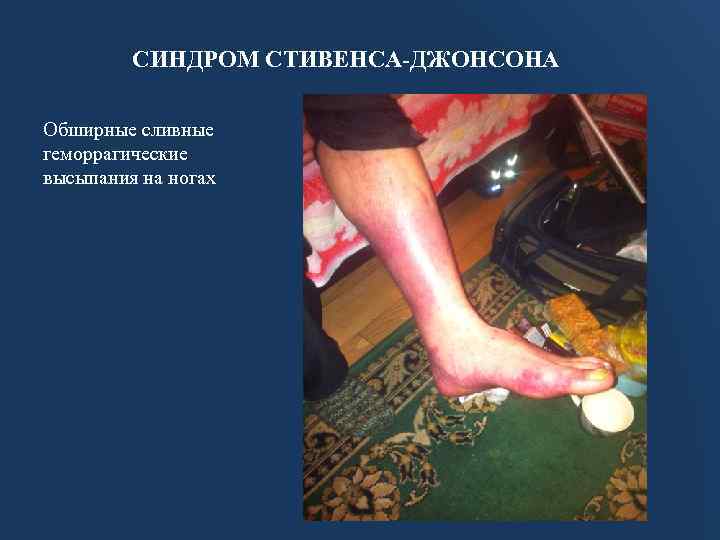 СИНДРОМ СТИВЕНСА-ДЖОНСОНА Обширные сливные геморрагические высыпания на ногах 